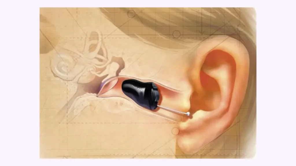 تصویر شماتیک سمعک داخل گوشی