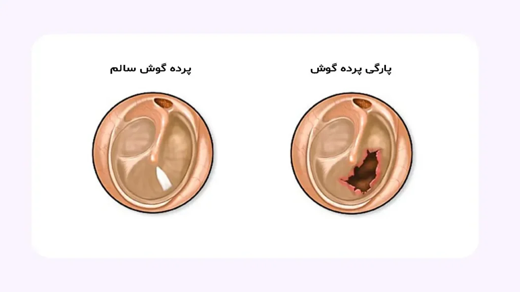 تصویر شماتیک از پارگی پرده گوش 