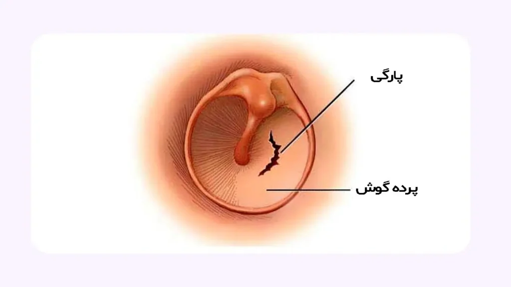 پارگی پرده گوش 