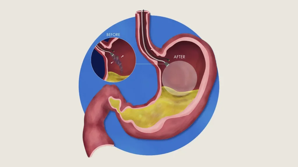 This image has an empty alt attribute; its file name is Schematic-illustration-of-the-gastric-balloon-procedure-1024x576.webp