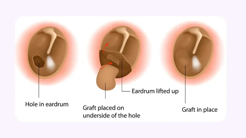 تمپانوپلاستی نوع 2
