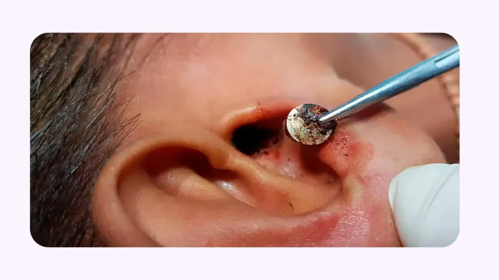 وجود جسم خارجی در گوش