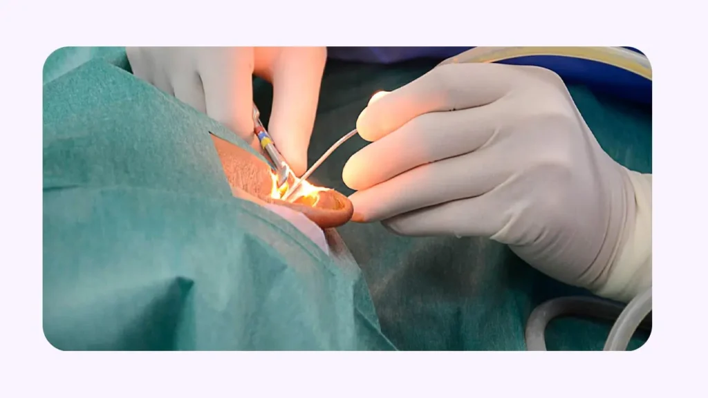 Transcanal Tympanoplasty