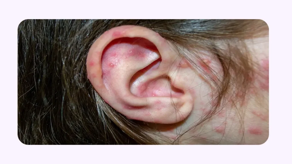 آلرژی و التهاب مجرای گوش