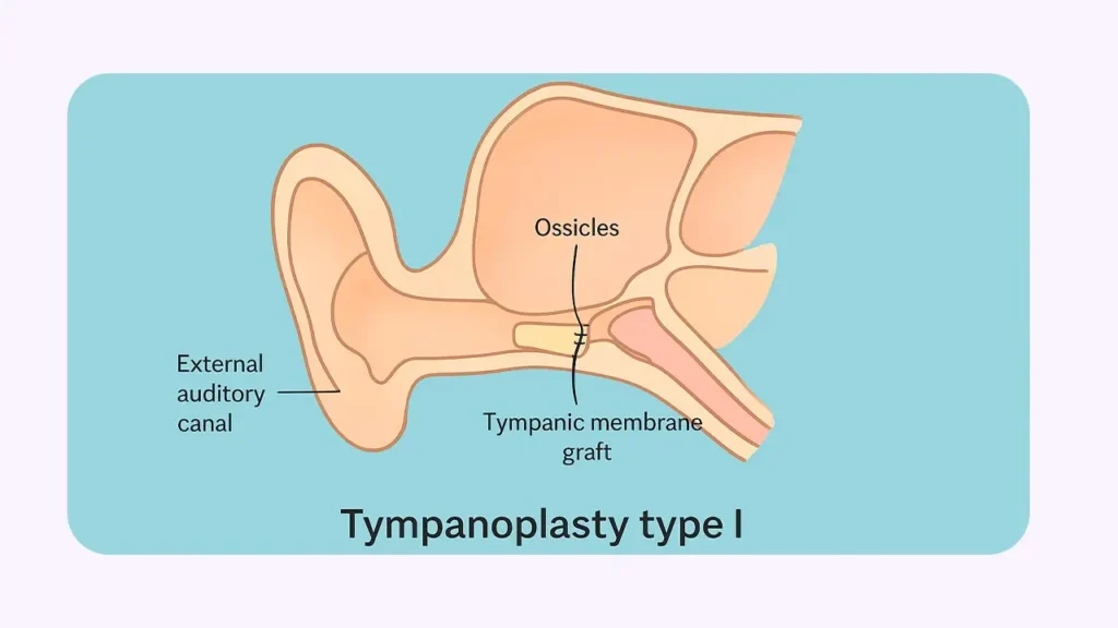 تمپانوپلاستی نوع 1