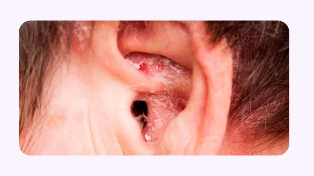 آلرژی و حساسیت گوش