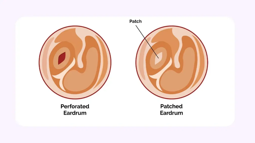 تمپانوپلاستی