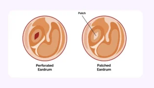 تمپانوپلاستی
