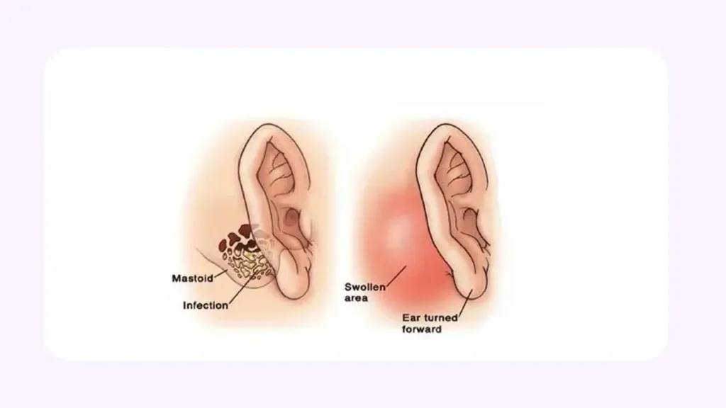 ماستوئیدیت