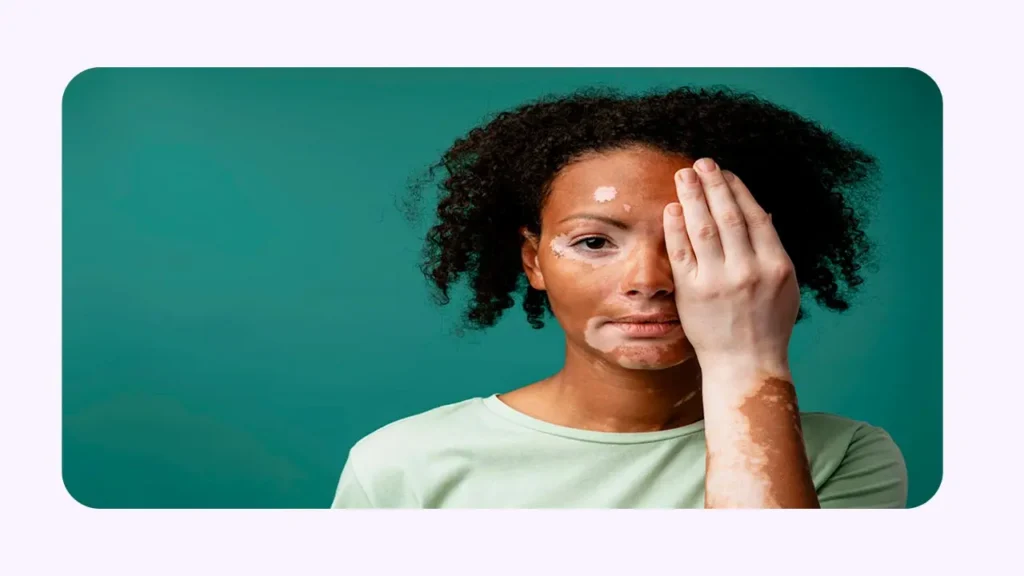 تصویر یک دختر مبتلا بیماری به پیسی 