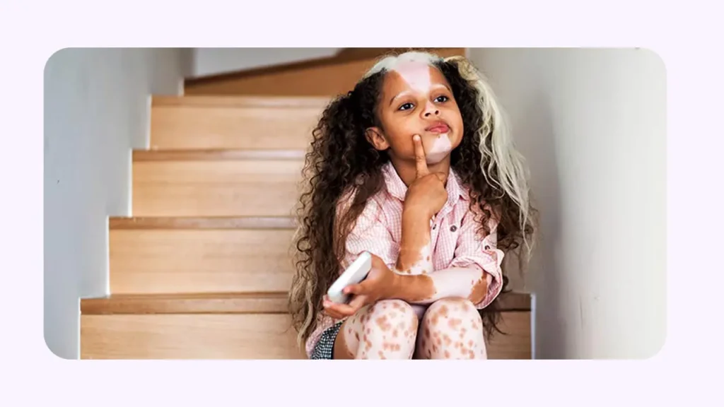 دختری با ابتلا به بیماری پیسی در حال فکر 