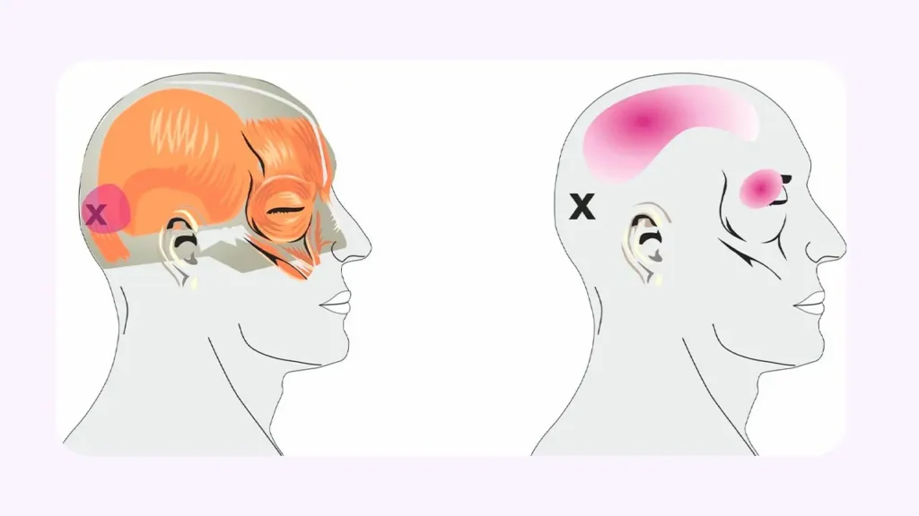 سر درد پشت گوش چیست؟