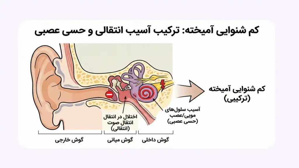 کم شنوایی آمیخته