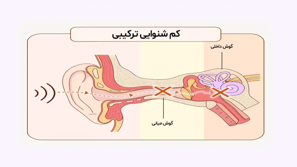 کم شنوایی ترکیبی