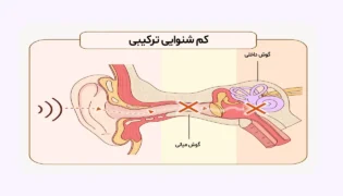 کم شنوایی ترکیبی