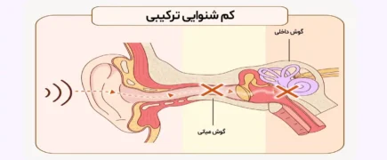 کم شنوایی ترکیبی