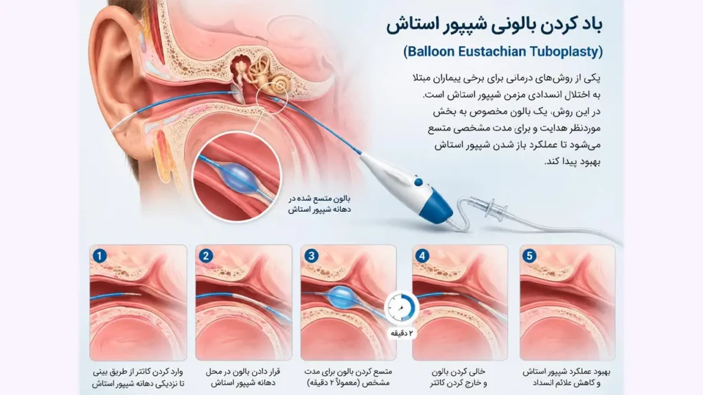 باد کردن بالونی شیپور استاش 