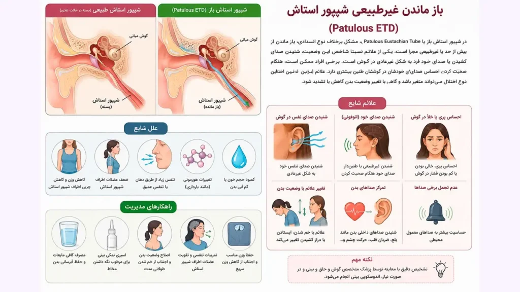 تصویر اینفوگرافیم از بازماندن غیر طبیعی شیپور استاش