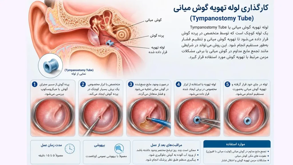 کارگذاری لوله تهویه گوش میانی