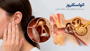 چسبندگی گوش (اتواسکلروز
