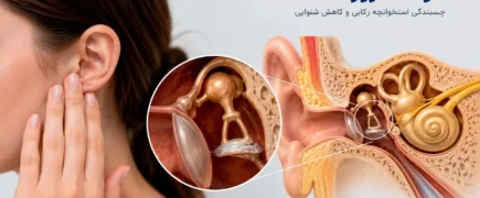 چسبندگی گوش (اتواسکلروز